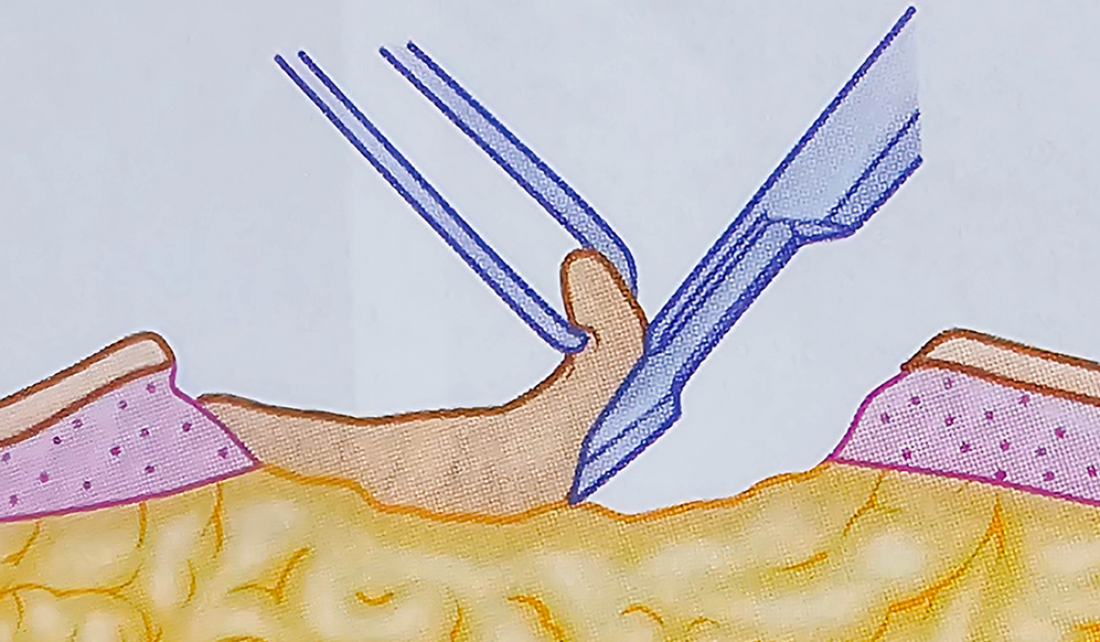 º¯¿¬ÀýÁ¦¼ú À̹ÌÁö